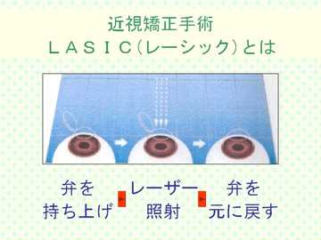 レーシックとはのイラスト1 近視矯正手術