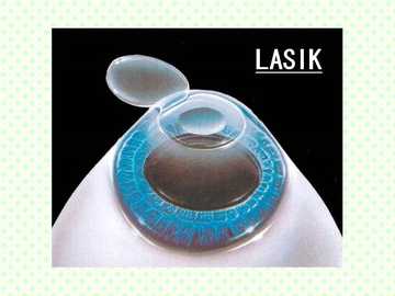 レーシックとはのイラスト2 LASIK