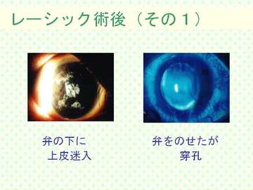 レーシック術後その1