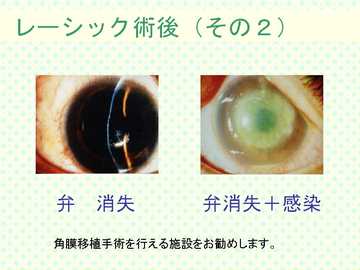 レーシック術後その2