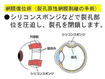 網膜復位術