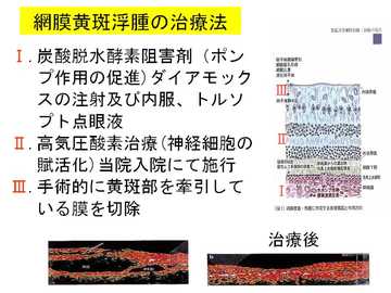 網膜黄斑浮腫の治療法