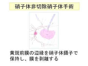硝子体非切除硝子体手術