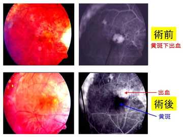 老人性黄斑出血02