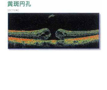 黄斑円孔01