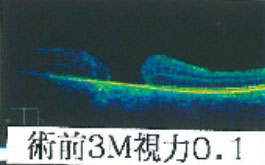 術前3M視力0.1