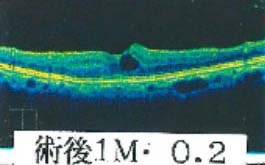 術前1M視力0.2