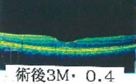 術前3M視力0.4
