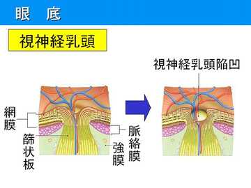 正常眼圧緑内障