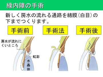 緑内障の手術