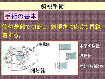 斜視手術についてのイラスト